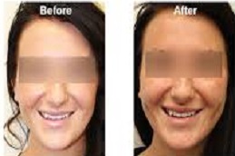 تكلفة جراحة ديمبل خلق في دبي وأبو ظبي والشارقة والعين