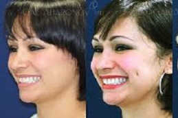 تكلفة جراحة ديمبل خلق في دبي وأبو ظبي والشارقة والعين