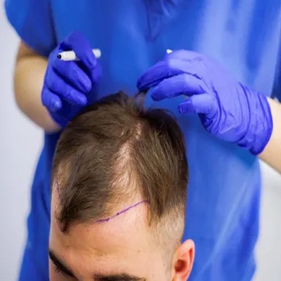 تكلفة زراعة الشعر باستخدام تقنية FUT في دبي