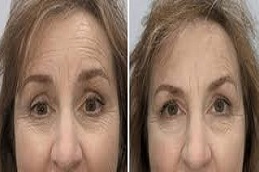 حقن ديسبورت في دبي