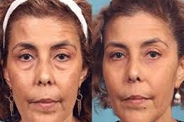 حقن ديسبورت في دبي