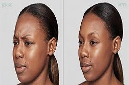 حقن ديسبورت في دبي