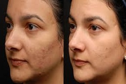 علاج المصفوفة الإلكترونية في دبي وأبو ظبي