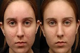 علاج المصفوفة الإلكترونية في دبي وأبو ظبي