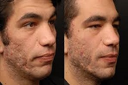 علاج المصفوفة الإلكترونية في دبي وأبو ظبي