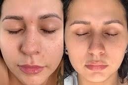 التقشير العضوي في دبي