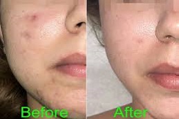 التقشير العضوي في دبي