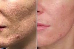 التقشير العضوي في دبي