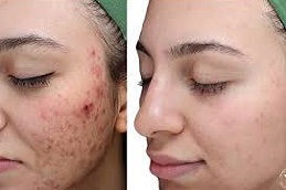 التقشير العضوي في دبي