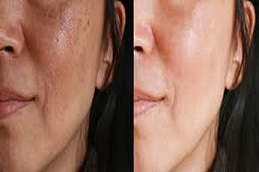 التقشير العضوي في دبي