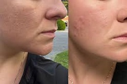 التقشير العضوي في دبي