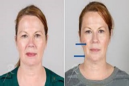 علاج ألثيرابي في دبي وأبوظبي