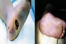 علاج الجروح المزمنة في دبي