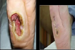 علاج الجروح المزمنة في دبي