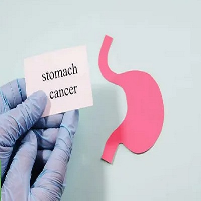 فحص سرطان المعدة في الإمارات فحص سرطان المعدة في الإمارات العربية المتحدة