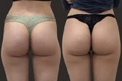 شد المؤخرة بالطريقة البرازيلية دبي وأبو ظبي والشارقة والعين