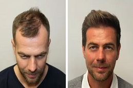 زراعة الشعر في دبي