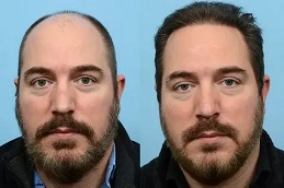 زراعة الشعر في دبي