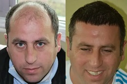 زراعة الشعر في دبي